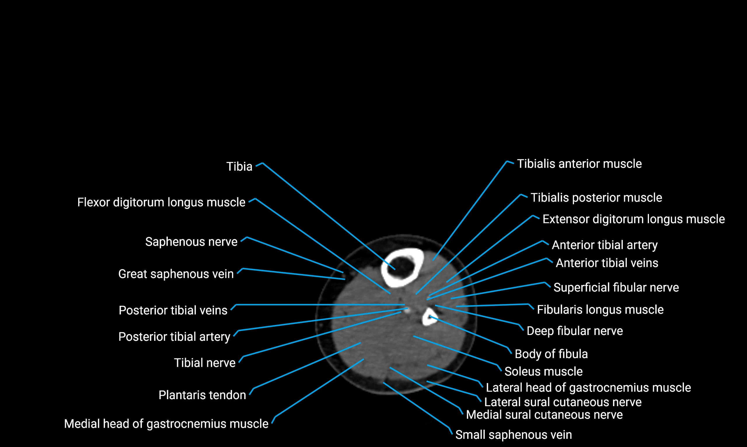 CT lower limb axial cross sectional anatomy labelled image 108 (2).webp